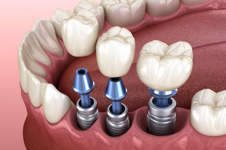 インプラントの隣の歯が使えなくなったら、またインプラントを埋入する