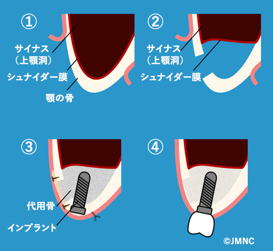 上顎洞底挙上術（サイナスリフト）