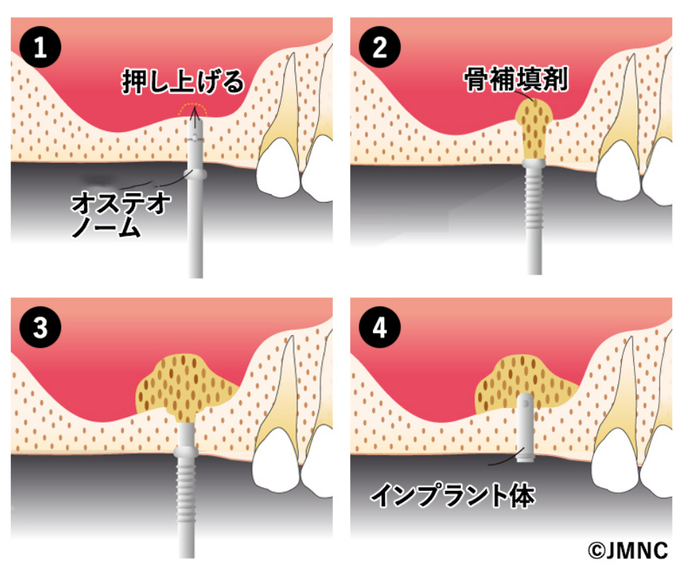 ソケットリフト